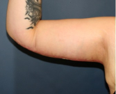 Feel Beautiful - Arm Reduction 203 - After Photo